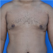 Male Breast Reduction After Photo by Jonathan Weinrach, MD; Scottsdale, AZ - Case 36842