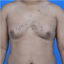 Male Breast Reduction Before Photo by Jonathan Weinrach, MD; Scottsdale, AZ - Case 36842