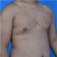 Male Breast Reduction After Photo by Jonathan Weinrach, MD; Scottsdale, AZ - Case 36842