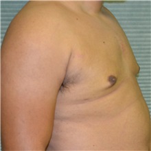 Male Breast Reduction After Photo by Jonathan Weinrach, MD; Scottsdale, AZ - Case 36843