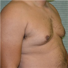 Male Breast Reduction Before Photo by Jonathan Weinrach, MD; Scottsdale, AZ - Case 36843