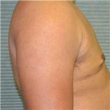 Male Breast Reduction After Photo by Jonathan Weinrach, MD; Scottsdale, AZ - Case 36843