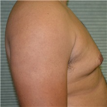Male Breast Reduction Before Photo by Jonathan Weinrach, MD; Scottsdale, AZ - Case 36843