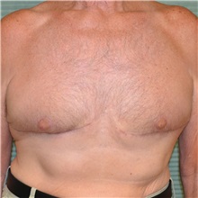 Male Breast Reduction After Photo by Jonathan Weinrach, MD; Scottsdale, AZ - Case 36847