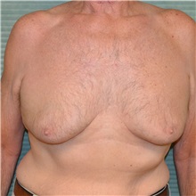 Male Breast Reduction Before Photo by Jonathan Weinrach, MD; Scottsdale, AZ - Case 36847
