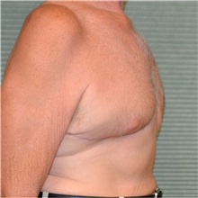 Male Breast Reduction After Photo by Jonathan Weinrach, MD; Scottsdale, AZ - Case 36847