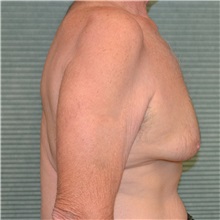 Male Breast Reduction Before Photo by Jonathan Weinrach, MD; Scottsdale, AZ - Case 36847
