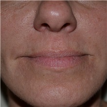 Dermal Fillers After Photo by Jonathan Weinrach, MD; Scottsdale, AZ - Case 36861