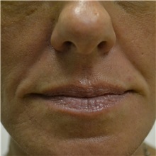 Dermal Fillers Before Photo by Jonathan Weinrach, MD; Scottsdale, AZ - Case 36861