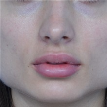Lip Augmentation/Enhancement After Photo by Jonathan Weinrach, MD; Scottsdale, AZ - Case 36863