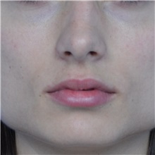 Lip Augmentation/Enhancement Before Photo by Jonathan Weinrach, MD; Scottsdale, AZ - Case 36863