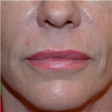 Lip Augmentation/Enhancement After Photo by Jonathan Weinrach, MD; Scottsdale, AZ - Case 36864