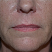 Lip Augmentation/Enhancement Before Photo by Jonathan Weinrach, MD; Scottsdale, AZ - Case 36864