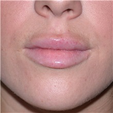 Lip Augmentation/Enhancement After Photo by Jonathan Weinrach, MD; Scottsdale, AZ - Case 36865