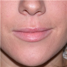 Lip Augmentation/Enhancement Before Photo by Jonathan Weinrach, MD; Scottsdale, AZ - Case 36865