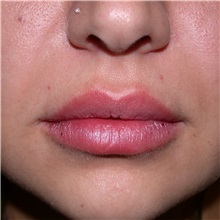 Lip Augmentation/Enhancement After Photo by Jonathan Weinrach, MD; Scottsdale, AZ - Case 36866
