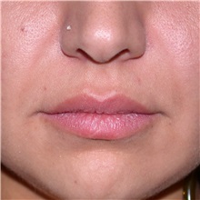 Lip Augmentation/Enhancement Before Photo by Jonathan Weinrach, MD; Scottsdale, AZ - Case 36866