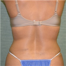 Liposuction After Photo by Jonathan Weinrach, MD; Scottsdale, AZ - Case 36868