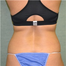 Liposuction Before Photo by Jonathan Weinrach, MD; Scottsdale, AZ - Case 36868