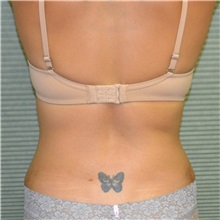 Liposuction After Photo by Jonathan Weinrach, MD; Scottsdale, AZ - Case 36870