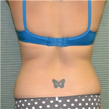 Liposuction Before Photo by Jonathan Weinrach, MD; Scottsdale, AZ - Case 36870