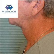 Neck Lift After Photo by Jonathan Weinrach, MD; Scottsdale, AZ - Case 36872