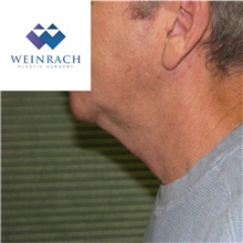 Neck Lift Before Photo by Jonathan Weinrach, MD; Scottsdale, AZ - Case 36872