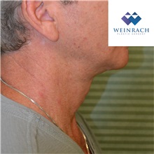 Neck Lift After Photo by Jonathan Weinrach, MD; ,  - Case 36872