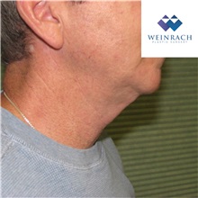 Neck Lift Before Photo by Jonathan Weinrach, MD; ,  - Case 36872