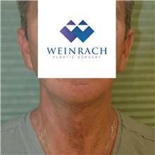 Neck Lift After Photo by Jonathan Weinrach, MD; ,  - Case 36872