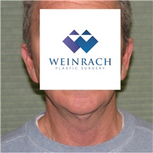 Neck Lift Before Photo by Jonathan Weinrach, MD; ,  - Case 36872