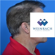 Neck Lift After Photo by Jonathan Weinrach, MD; Scottsdale, AZ - Case 36874