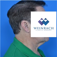 Neck Lift Before Photo by Jonathan Weinrach, MD; Scottsdale, AZ - Case 36874