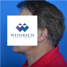 Neck Lift After Photo by Jonathan Weinrach, MD; Scottsdale, AZ - Case 36874