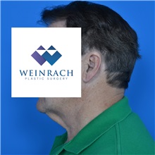 Neck Lift Before Photo by Jonathan Weinrach, MD; Scottsdale, AZ - Case 36874