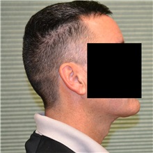 Neck Lift After Photo by Jonathan Weinrach, MD; Scottsdale, AZ - Case 36875