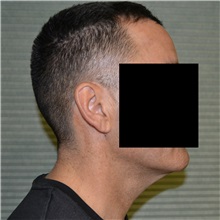 Neck Lift Before Photo by Jonathan Weinrach, MD; Scottsdale, AZ - Case 36875