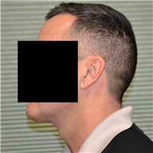 Neck Lift After Photo by Jonathan Weinrach, MD; Scottsdale, AZ - Case 36875