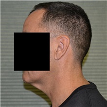 Neck Lift Before Photo by Jonathan Weinrach, MD; Scottsdale, AZ - Case 36875