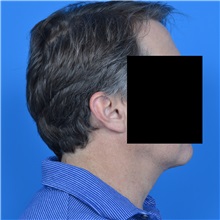 Neck Lift After Photo by Jonathan Weinrach, MD; Scottsdale, AZ - Case 36876