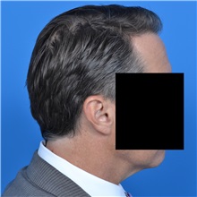 Neck Lift Before Photo by Jonathan Weinrach, MD; Scottsdale, AZ - Case 36876