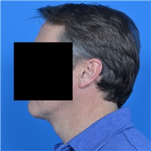 Neck Lift After Photo by Jonathan Weinrach, MD; ,  - Case 36876