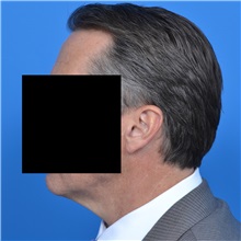 Neck Lift Before Photo by Jonathan Weinrach, MD; ,  - Case 36876