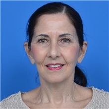 Facelift After Photo by Jonathan Weinrach, MD; Scottsdale, AZ - Case 36884