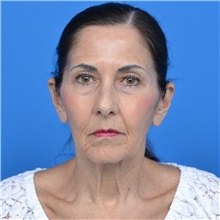 Facelift Before Photo by Jonathan Weinrach, MD; Scottsdale, AZ - Case 36884