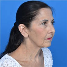 Facelift Before Photo by Jonathan Weinrach, MD; ,  - Case 36884
