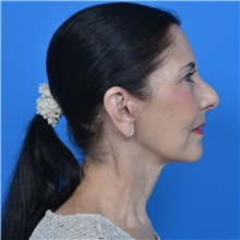 Facelift After Photo by Jonathan Weinrach, MD; ,  - Case 36884