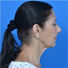 Facelift Before Photo by Jonathan Weinrach, MD; ,  - Case 36884