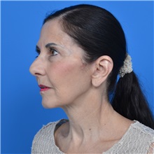Facelift After Photo by Jonathan Weinrach, MD; ,  - Case 36884