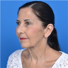Facelift Before Photo by Jonathan Weinrach, MD; ,  - Case 36884